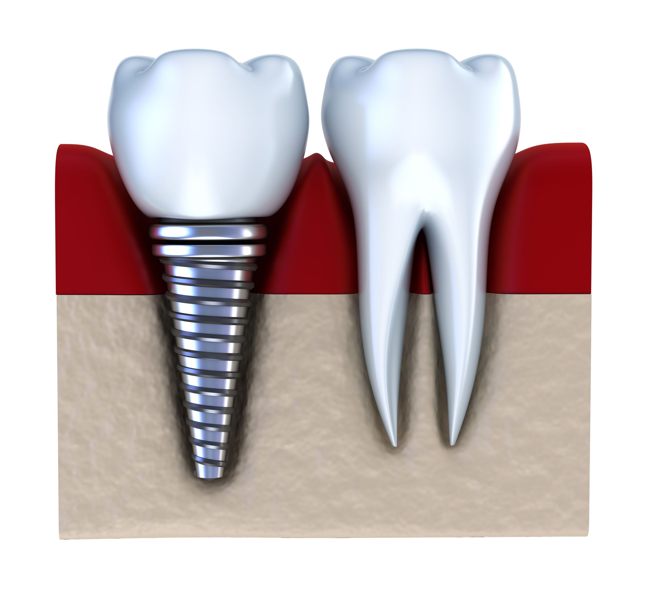 What Happens After Getting Dental Implants in Queens NY