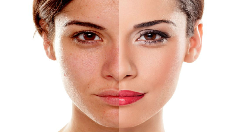 Seeking Help for Hyperpigmentation in Peachtree City