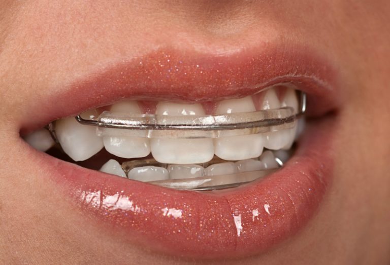 Improving Yourself with Invisalign in St Augustine