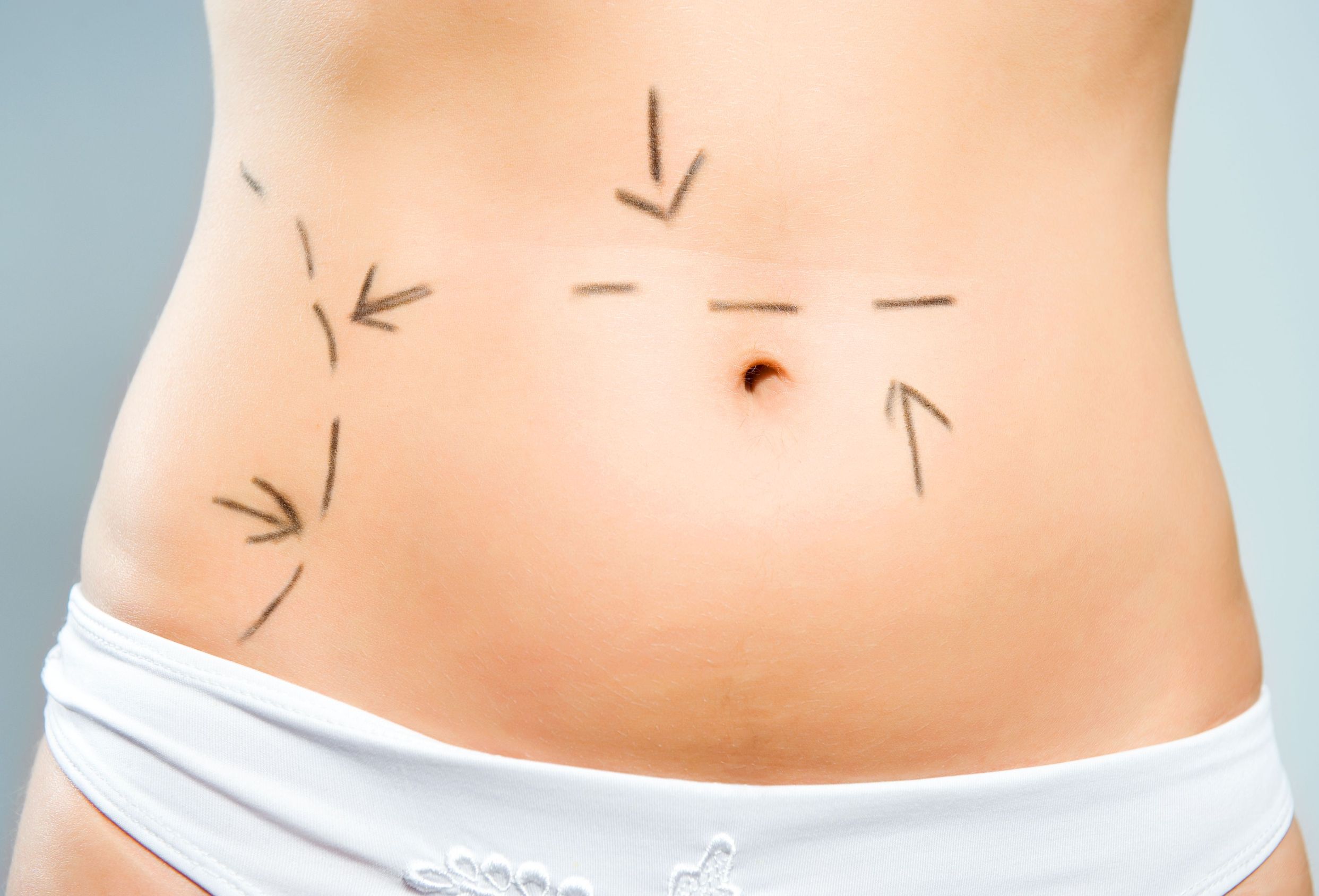 Tummy Tuck in Hinsdale: What to Expect