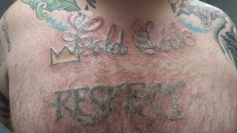 A Local Business is Ready to Help You with Tattoo Removal in Minneapolis, MN