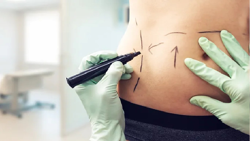 Regaining Your Confidence Post-Liposuction on Chin in Minneapolis, MN