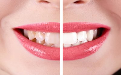 Transform Your Smile with Cosmetic Dentistry Glendale NY Solutions for Lasting Confidence