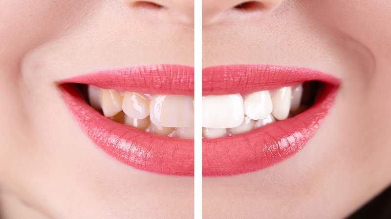 Transform Your Smile with Cosmetic Dentistry Glendale NY Solutions for Lasting Confidence