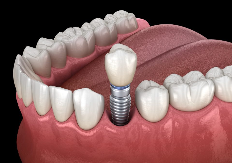 Find the Lasting Solution for Missing Teeth with Dental Implants Boise ID