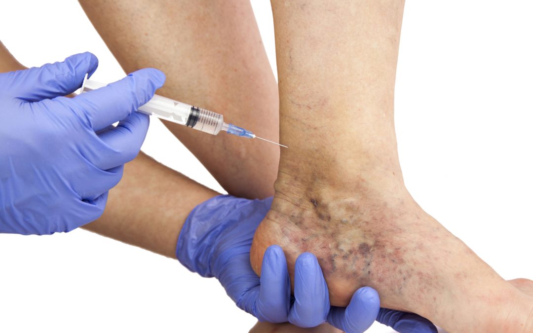 PRP Therapy Aventura and Its Role in Non Surgical Joint Pain Relief for Active Lifestyles