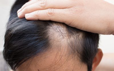 Boost your confidence with a Hair Restoration Specialist Williamsville NY trusted by locals