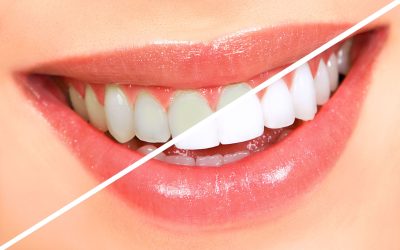 Get Your Smile Back Fast with same-day crowns in Blue Earth, MN for Lasting Dental Solutions