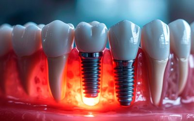 Transform Your Smile with Dental Implants in North Little Rock AR Residents Trust for Lasting Results